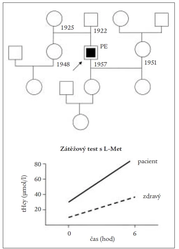 Rodokmen a pozitivní výsledek zátežového methioninového testu u pacienta s embolií plicnice a hyperhomocysteinemií z deficitu kobalaminu.