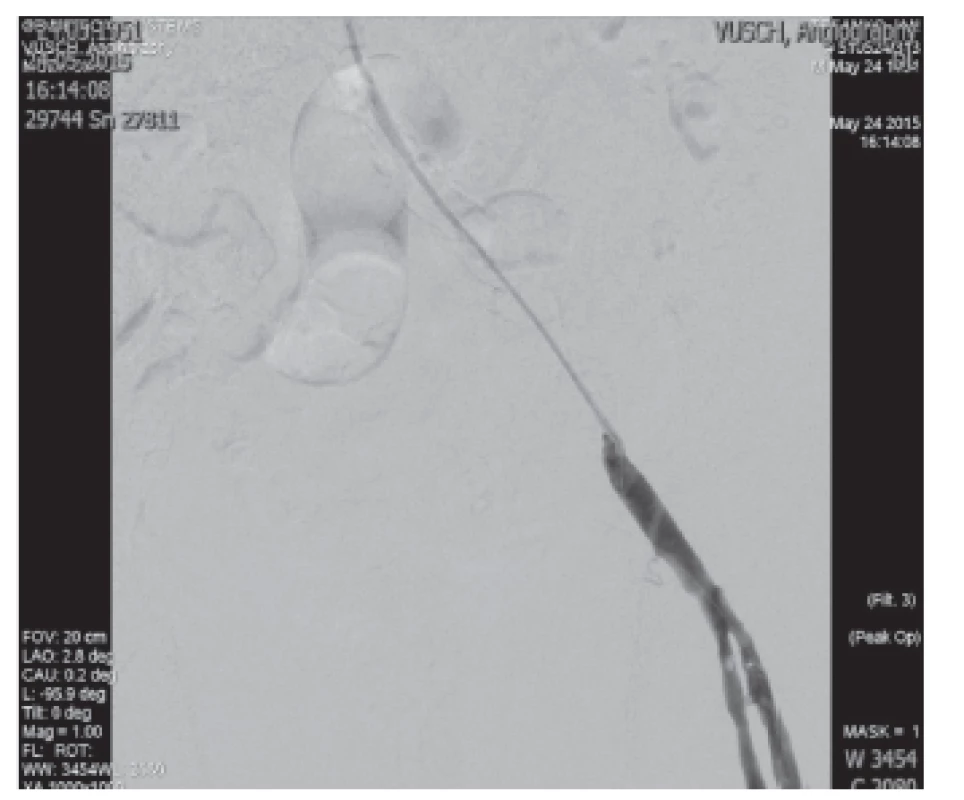 Implantácia balón-expandibilného stentu do AIE l.sin.
Fig. 6: Implantation of the baloon expandible stent in AIE l.sin.