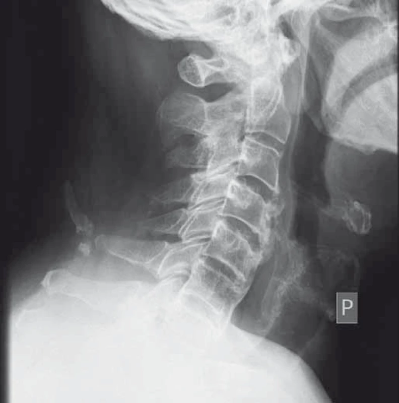 Kontrolní RTG po šesti měsících (kazuistika 1).
Fig. 5. Follow-up X-ray after six months (a case report 1).