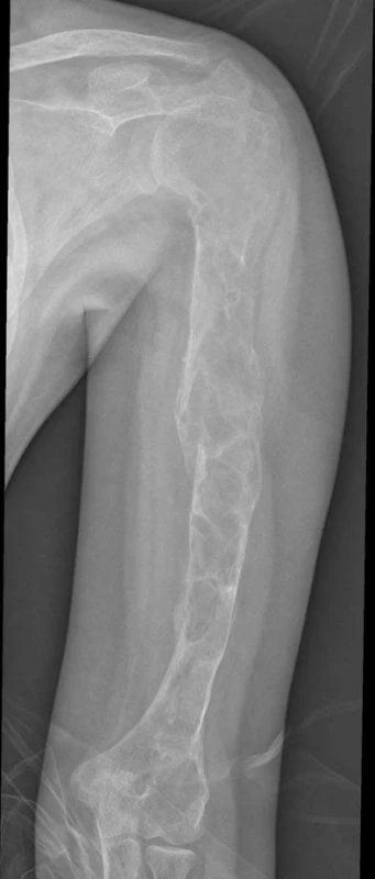 ľavý humerus – poroticky zmenená štruktúra v celom rozsahu s viacpočetnými cystickými prejasneniami a stav po patologickej fraktúre v oblasti diafýzy. 
Fig. 2. Left humerus – completely altered structure with multiple cystic changes and status after a pathologic fracture of the diaphysis zone.