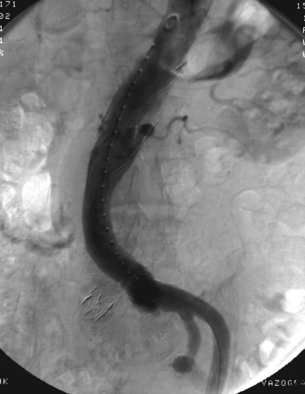Aortografie se intersegmentárním endoleakem typu III s plnící se dutinou ve vaku a odtokem k.l. do lumbálních tepen vlevo
Fig. 3. Aortography with intersegmental endoleak III with filling of cavity in sac and outflow via lumbar left arteries