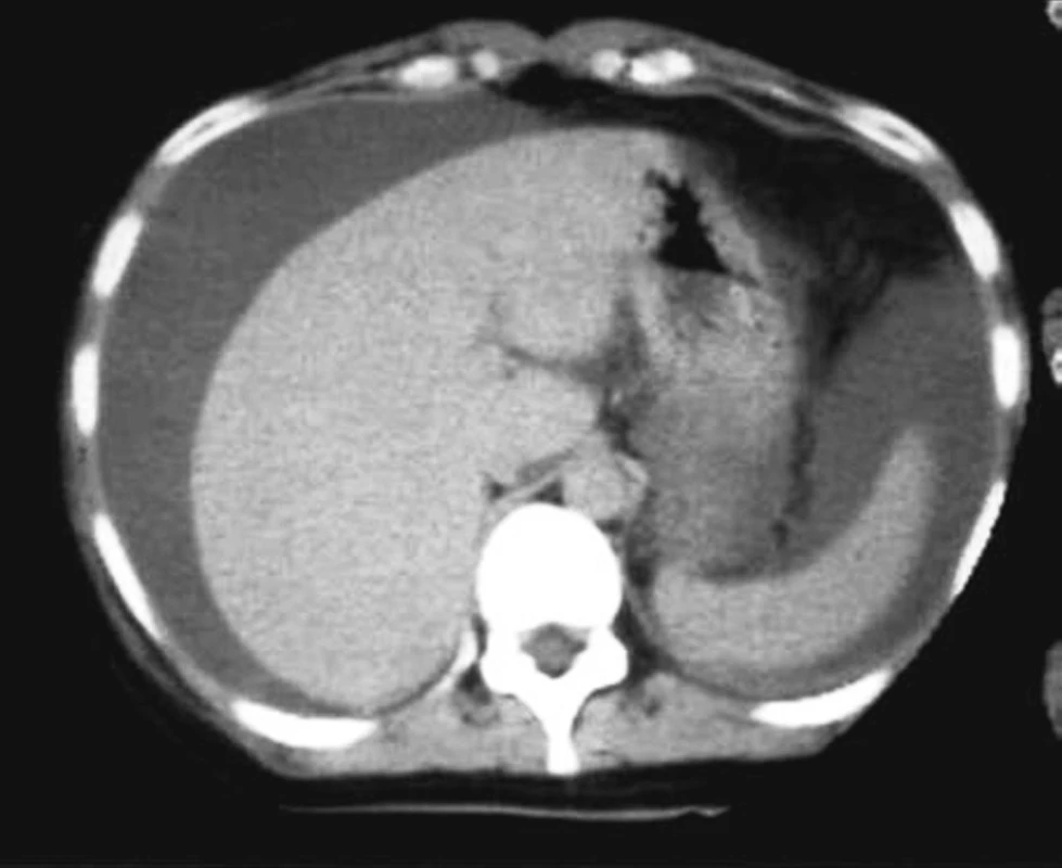 Počítačová tomografia: ascites – perihepatálna a perisplenická kolekcia
Fig. 3. Computed tomography: ascites – perihepatic and perisplenic collection