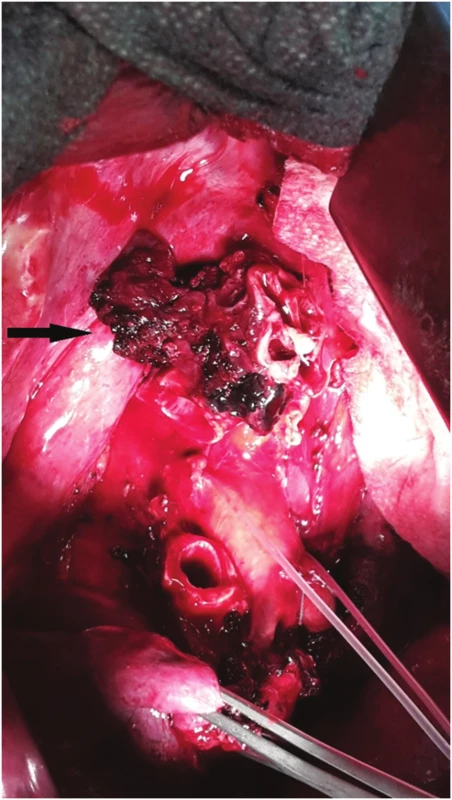Nádorové postižení kariny, stav po horní lobektomii vpravo
Fig. 3: Tumor of the carina; status after right upper lobectomy