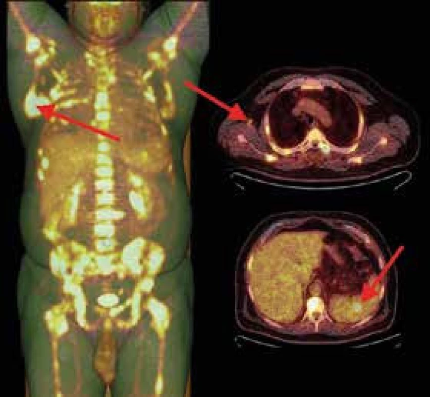 <sup>18</sup>F-FDG PET/low-dose CT vyšetření.