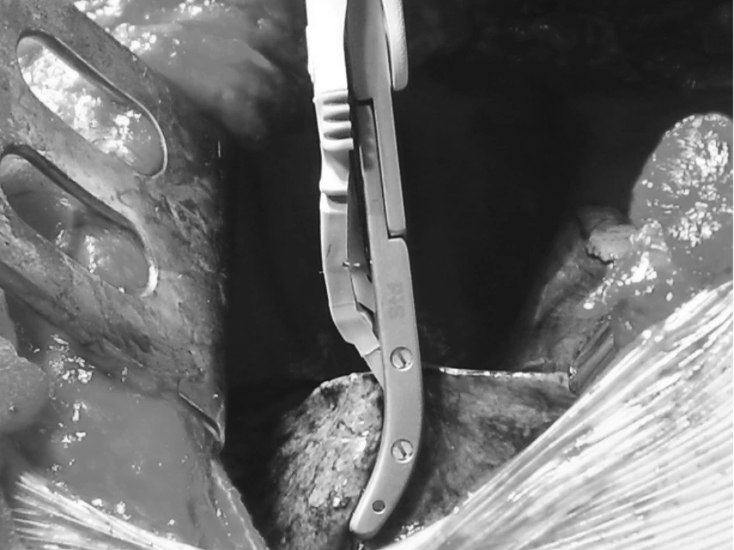 Resekce metastáz s pomocí LigaSure™
Pic. 2. Metastasectomy with the help of LigaSure™ device