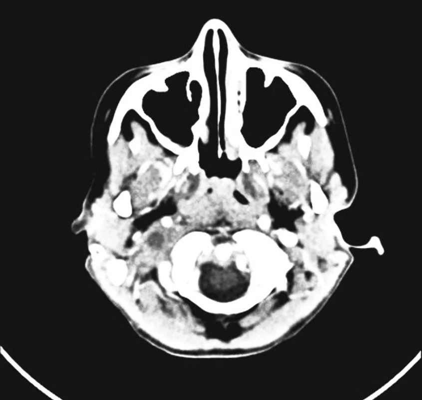 Trombóza sinus sigmoideus l. dx., kaudálně přestupující na VJI l. dx.