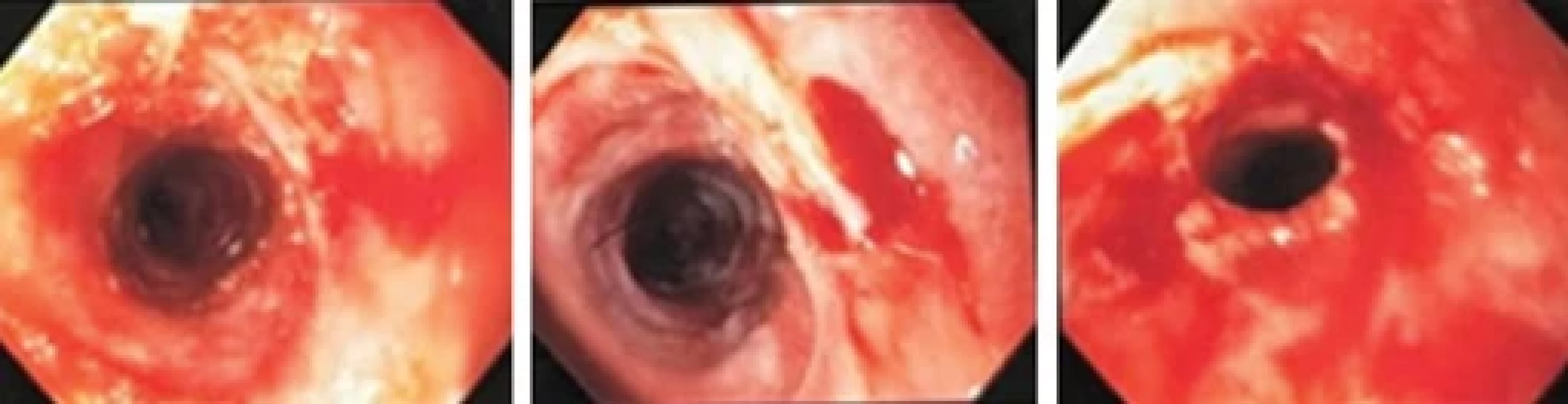 Upper GI endoscopy showing post corrosive intake oesophagitis, oesophageal stricture and gastritis.