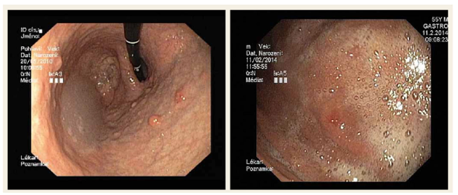 Neuroendokrinní nádor žaludku.
Fig. 1. Neuroendocrine tumour of the stomach.
