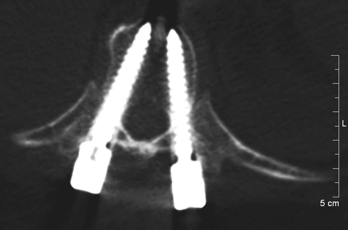 Příklad anatomicky správného zavedení pedikulárních šroubů v etáži druhého hrudního obratle Oba šrouby sledují osu pediklů a jejich hroty jsou umístěny subkortikálně.
Fig. 3: Correct anatomical position of pedicle screws inserted into the second thoracic vertebra Both shafts follow the axis of the pedicle with subcortical position of the tips.