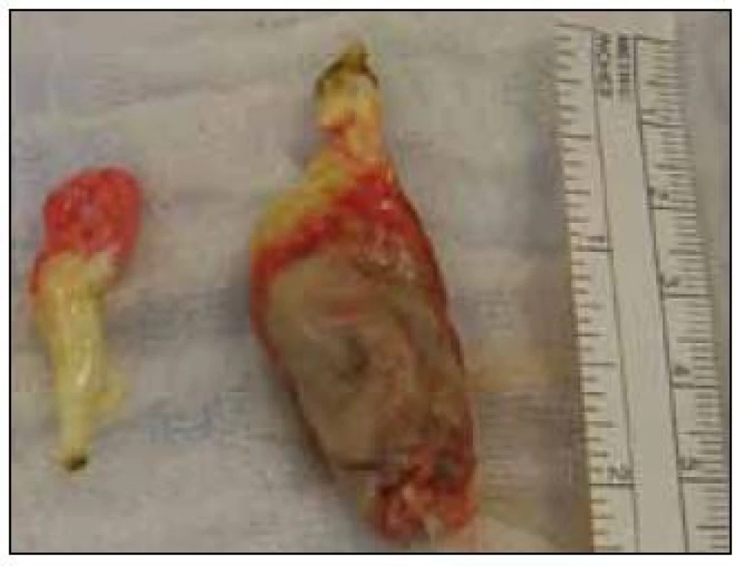 Při srdeční operaci odstraněn tumor levé síně gelatinózní konzistence, velikosti 6 × 1 × 3 cm, na jeho okrajích byly vlající útvary připomínající vegetace. Další, sekundární útvar želatinózní konzistence extripován v oblasti posteromediální komisury v úrovni předního cípu velikosti 1 × 2 cm.
