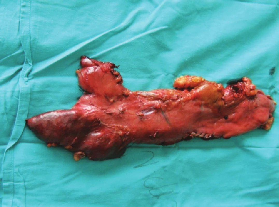 Resekát žalúdka so zvyškom GEA
Fig. 2. Gastric resecate with GEA (gastro-entero anastomosis)