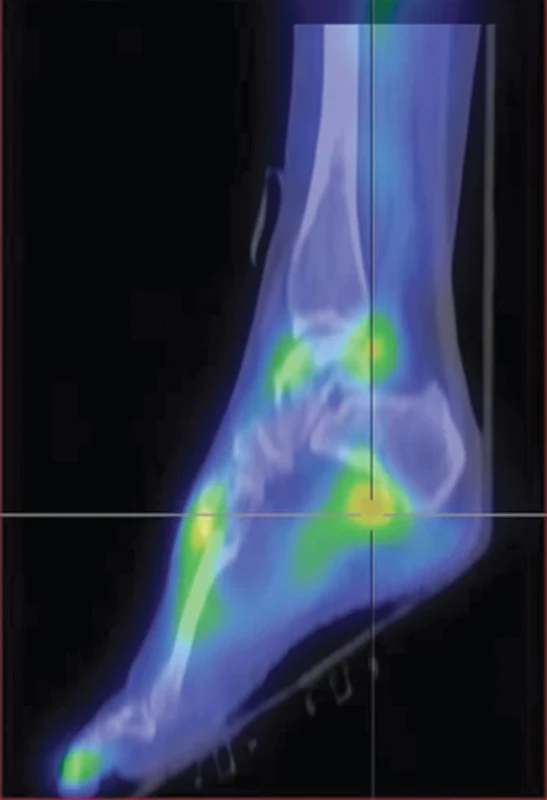 Fúze SPECT/CT časné fáze v sagitálním řezu – plantární fasciitida, zvýšený krevní pool v místě úponu plantární fascie na kost patní.