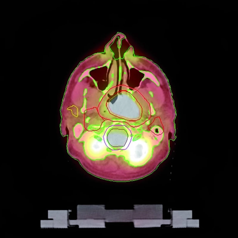 Zakreslení cílových objemů a kritických orgánů v PET/CT snímku.
