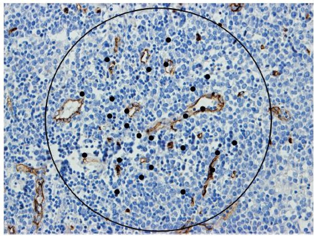 Projekce Chalkley count mřížky na mantle cell lymfom (protilátka CD34, zvětšení 200x).