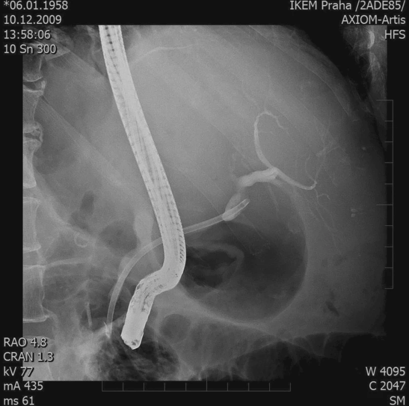 ERCP – stenóza žlučovodu, 1 stent
Fig. 3. ERCP – biliary duct stenosis, 1 stent