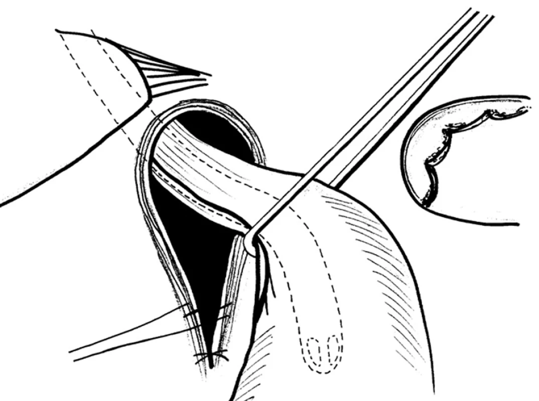 Klasická zadní hiátorafie za pomoci trakce
Fig. 18: Posterior hiatoraphy with the aid of the traction