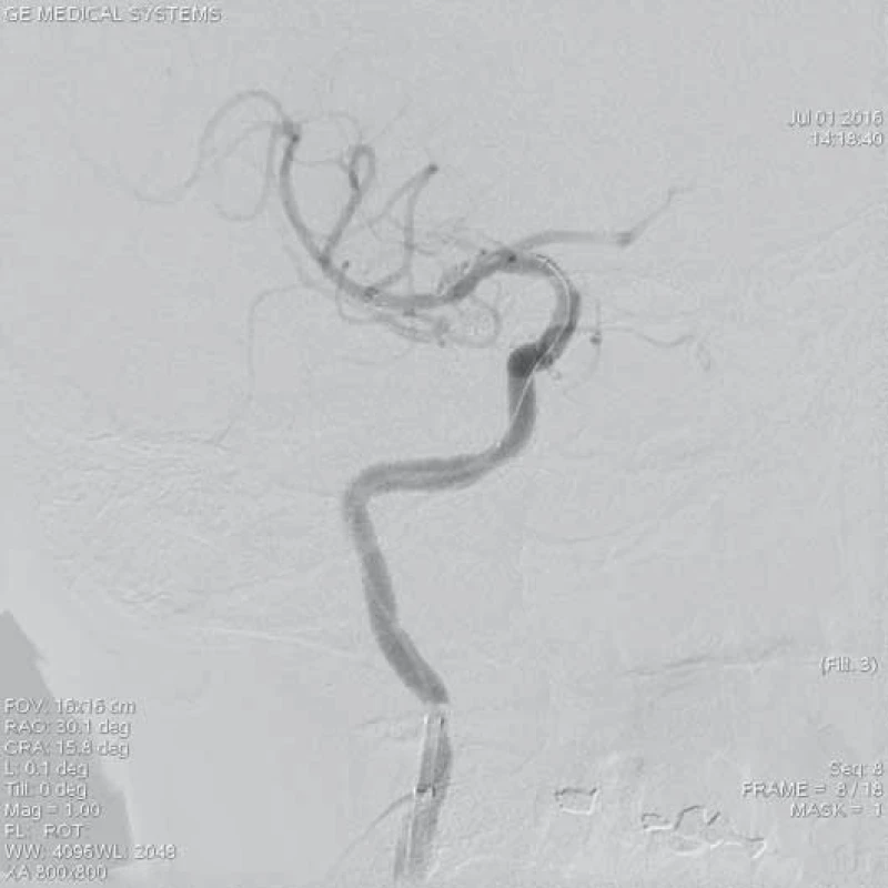Rozvinutý stent-retriever Solitaire AB 6 × 20 mm v místě uzávěru M1 úseku ACM l.dx. po dobu 5 min.