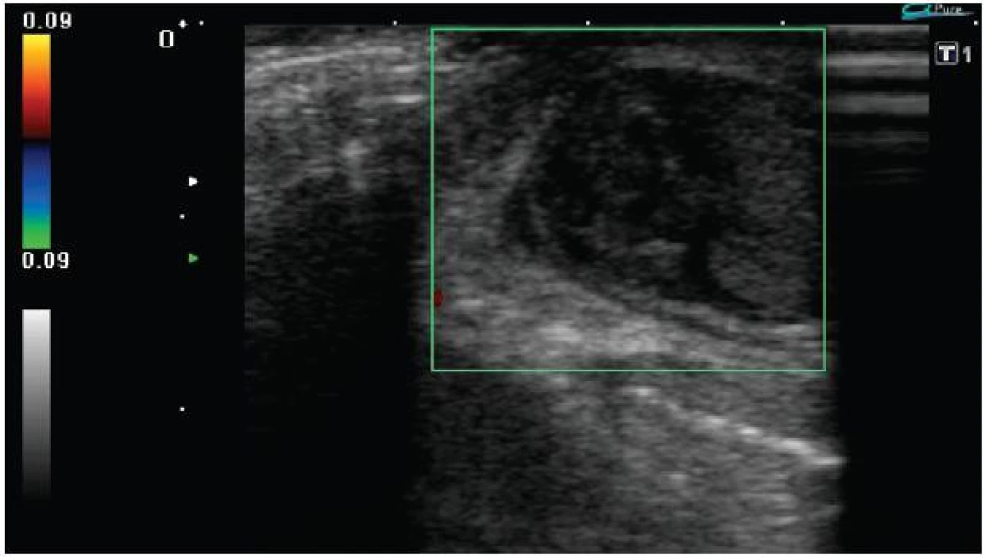 Ultrazvukové vyšetření barevným Dopplerem pravého varlete: je patrna nehomogenní struktura horního pólu varlete, chybí signál perfúze ve varleti
Fig. 1: Doppler ultrasonography of right testicle: upper pole of testis is nonhomogeneous, signs of perfusion are not detected