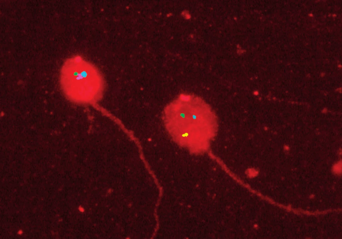 Fluorescenční in situ hybridizace na spermiích: signály pro chromozomy 21 (zelený), 18 (modrý), X (růžový), 13 (červený) a Y (žlutý)
Fig. 1. Fluorescence in situ hybridization in sperms: signals for chromosomes 21 (green), 18 (blue), X (pink), 13 (red) and Y (yellow)