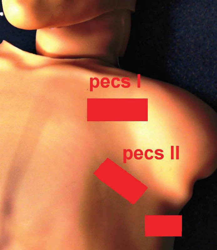 Poloha sondy při pecs I, pecs II a serratus anterior plane (sap) bloku