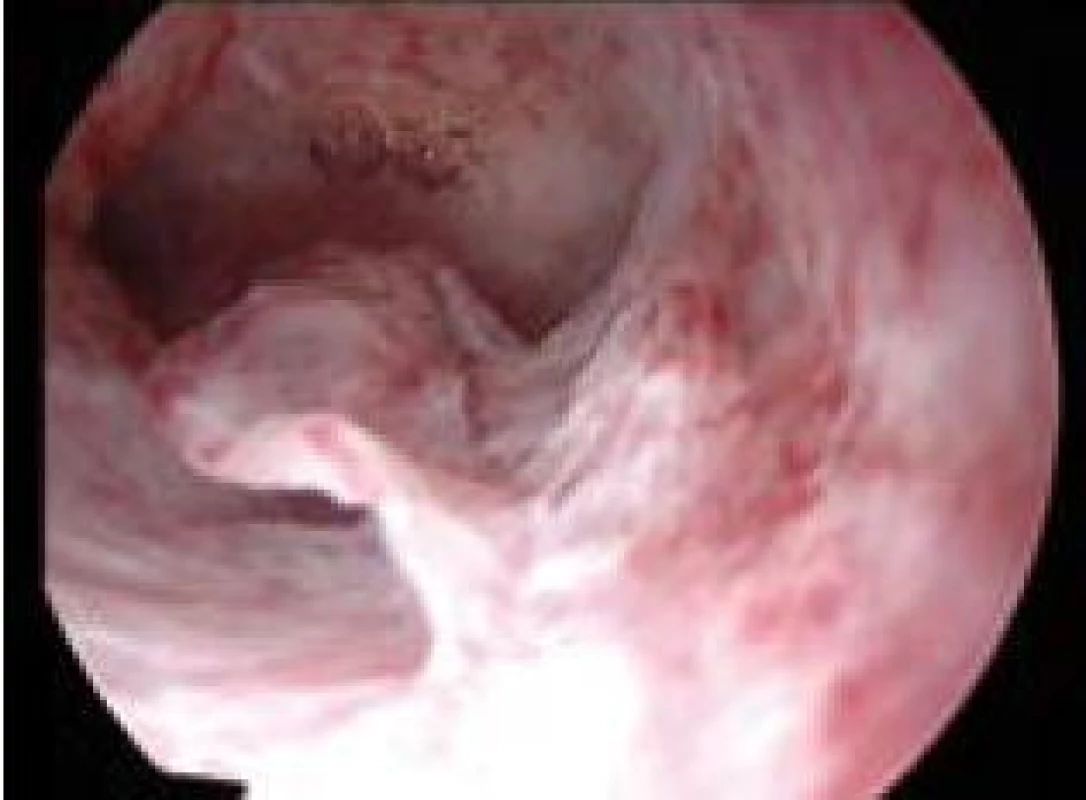 Drobný vlající polyp.
