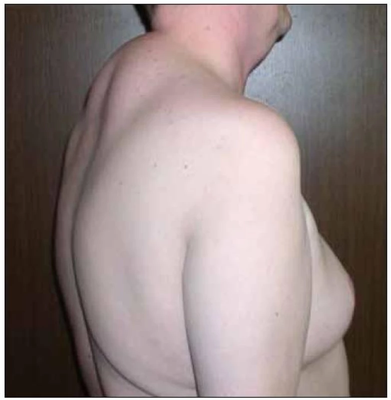 Lipohypertrofie na hrudníku a v dorzocervikální oblasti (tzv. „buffalo hump“).