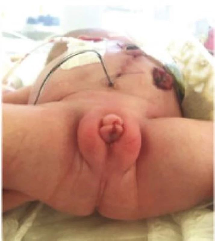 Novorozenec s jediným otvorem na perineu
mezi malými stydkými pysky, druhý den po porodu
a založení sigmoideostomie, vezikostomie a vaginostomie
pro hydrocolpos<br>
Fig. 1. A neonate with a single perineal orifice between
the labia minora; day 2 after delivery and creation
of sigmoidostomy, vesicostomy, and vaginostomy
for hydrocolpos.