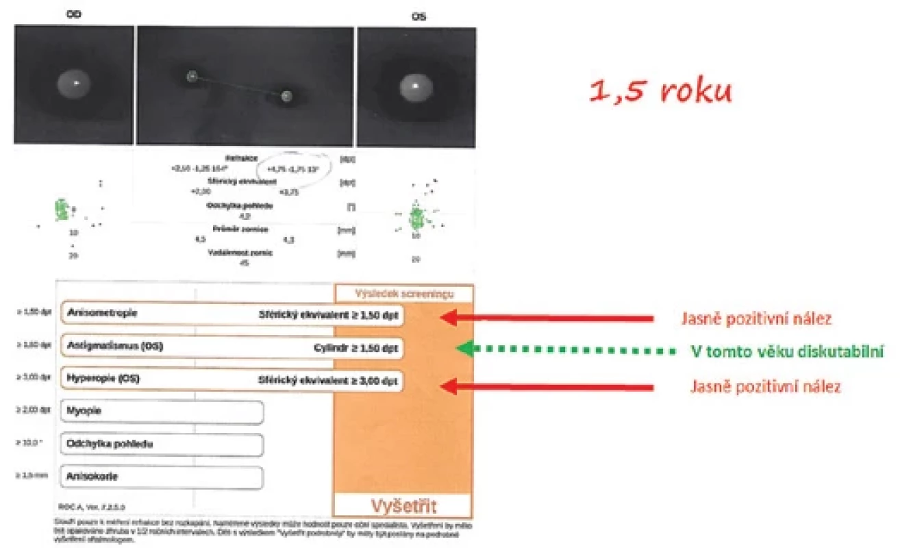 Pozitivní nález anizometropie a hypermetropie a hraniční nález astigmatismu na pozitivním certifikátu testu POX – poslat oftalmologovi