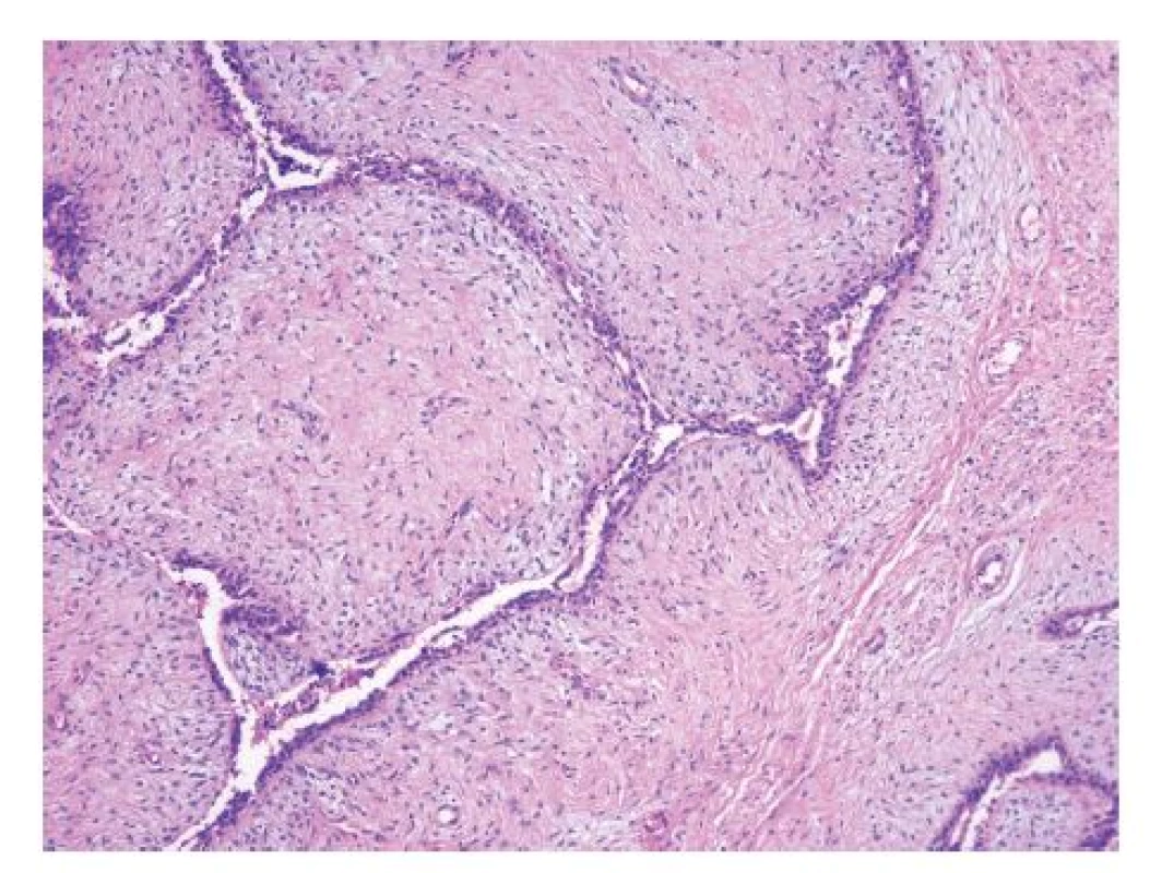 Mamografie – maligní fyloidní tumor v centru levého prsu 5x6 cm
Fig. 3: Mammography – malignant phyllodes tumour in the centre of the left breast, 5x6 cm