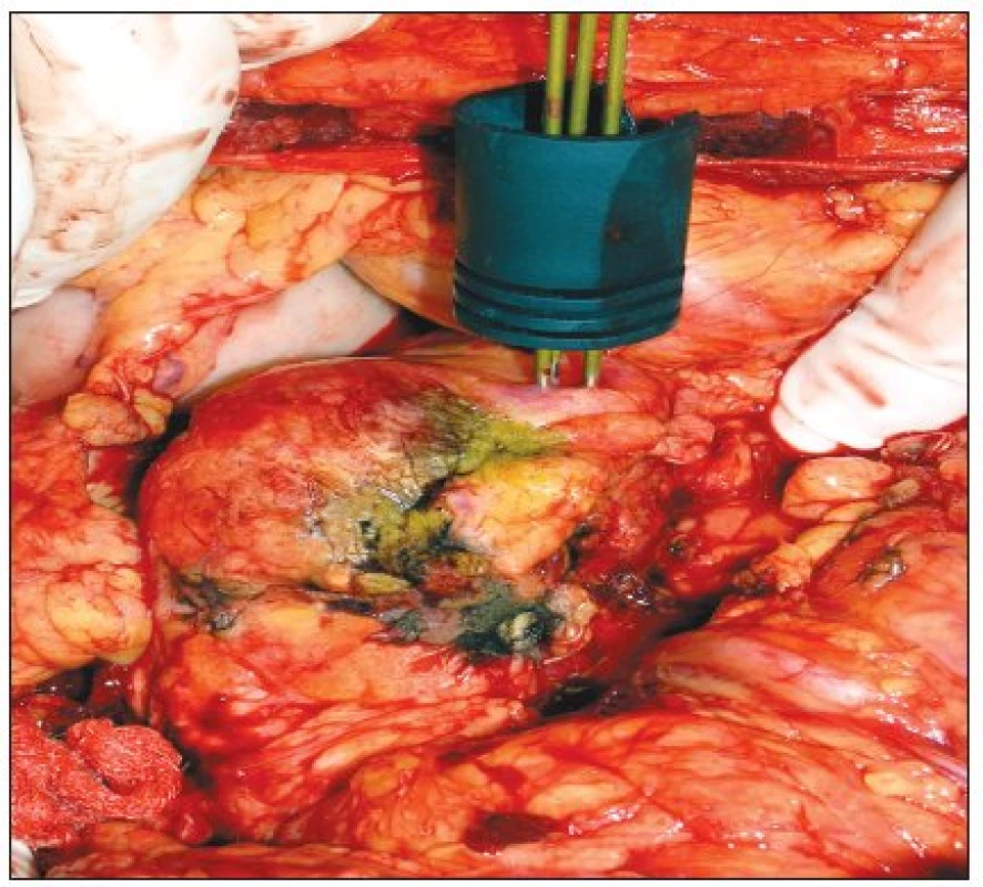 RFAmaligního neuroendokrinního tumoru těla pankreatu pomocí cluster elektrody
Fig. 1. RFA of a malignant pancreatic neuroendocrine tumor, using a cluster electrode.