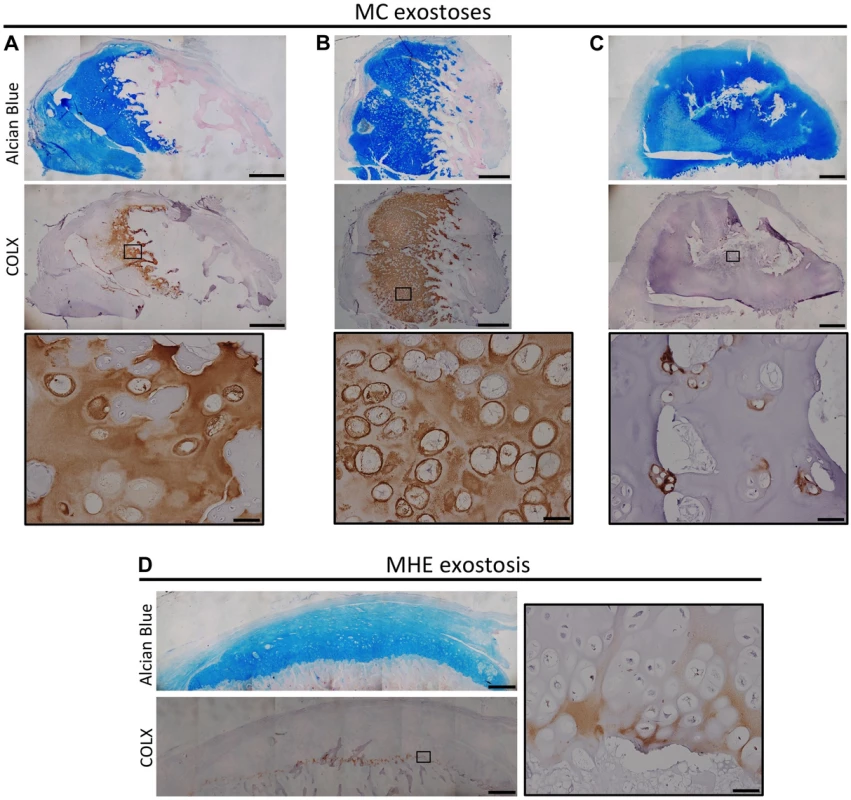 Disorganized distribution of COLX in exostoses from MC patients.