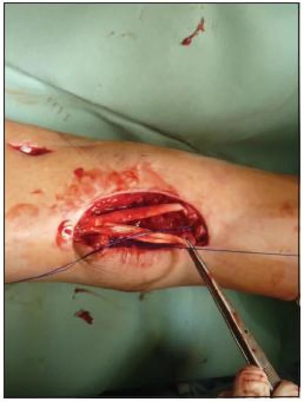 Náhrada šlachy m. extensor hallucis longus pomocí šlachy m. tibialis anterior (KÚCH)