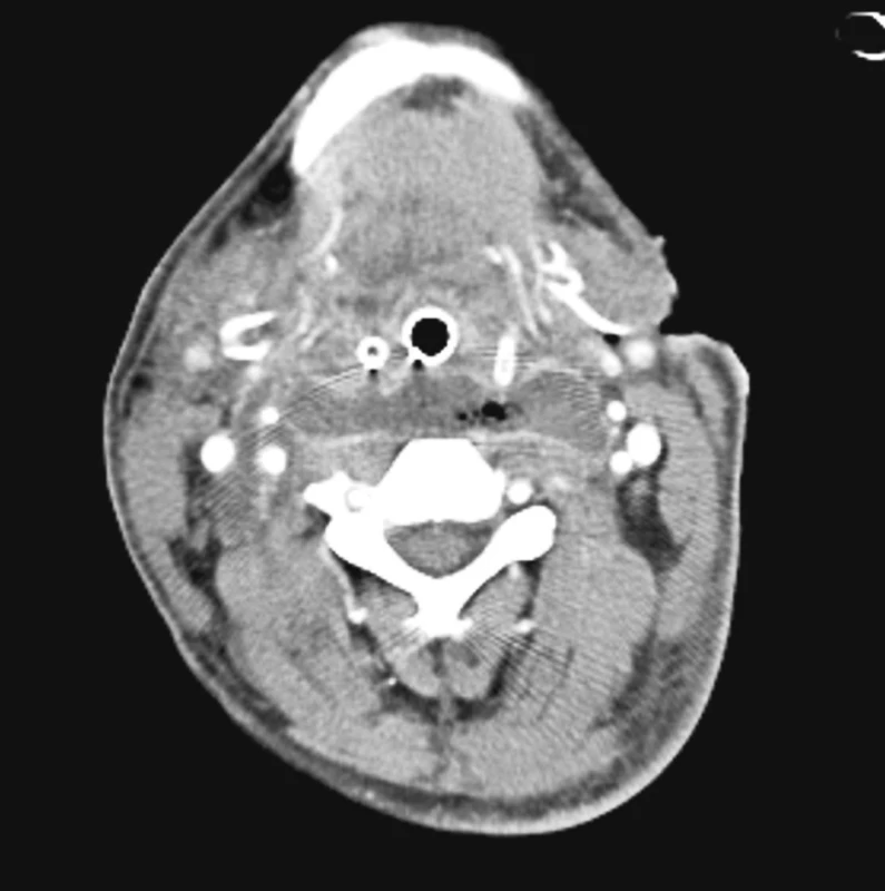 Axiální obraz CT s prevertebrálním abscesem
Fig. 1. Axial CT view depicting a prevertebral abscess