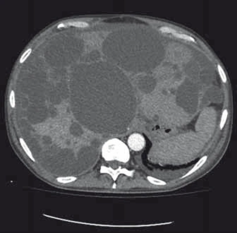 Polycystické postižení jater a ledvin, CT – transverzální řez.
Fig. 1. Polycystic liver and kidney disease, CT – transverse plane.