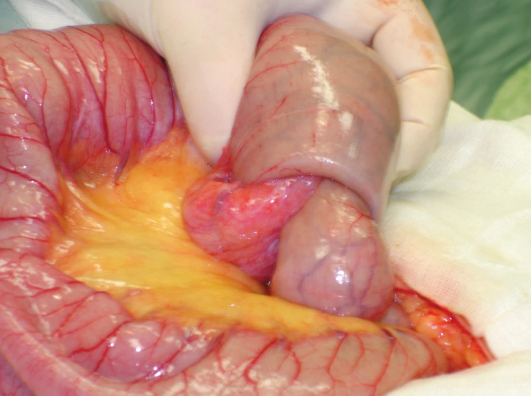 Invaginace jejuna
Fig. 4. Jejunal invagination