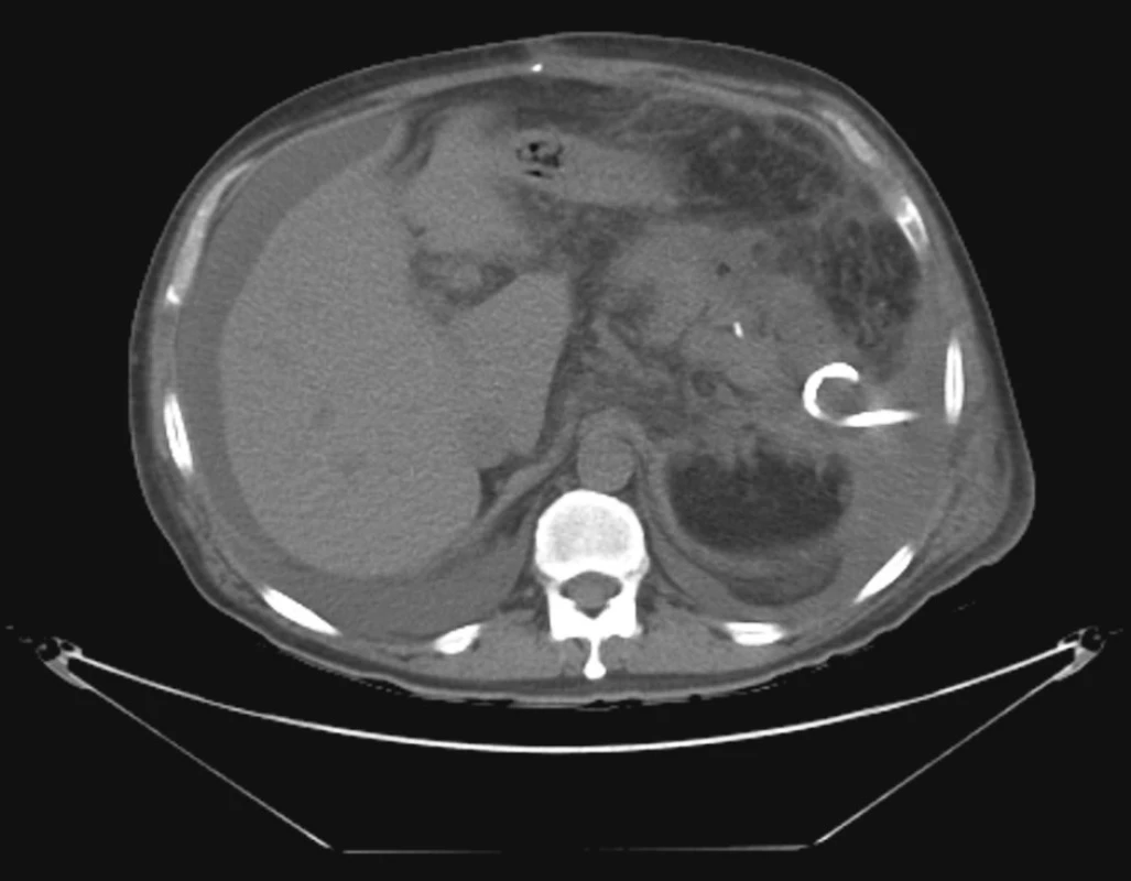 Drenáž abscesu v levém hypochondriu perkutánně pod CT kontrolou
Fig. 3. CT-controlled drainage of an abscess in the left hypochondrium