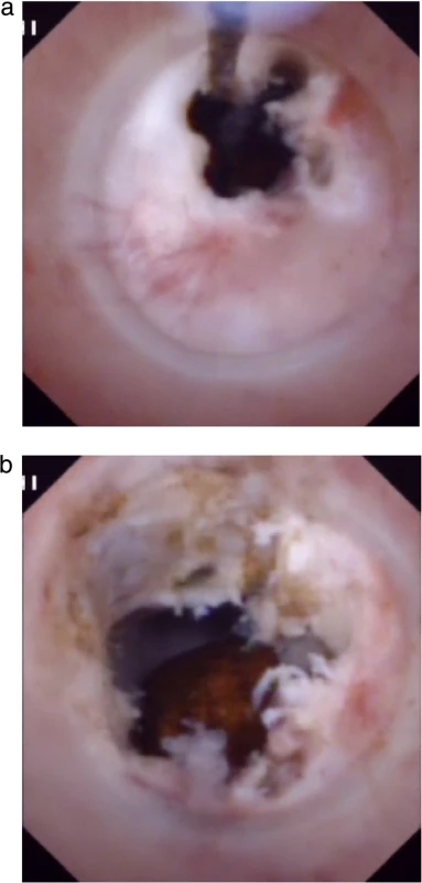 Choledochoscopic high-frequency needle-knife electrotomy was performed for anastomotic strictures: a) The strictured opening is cut gradually under direct vision with no sign of bleeding. b) The fibrous tissue of the anastomosis has been removed and a stone can be seen in intrahepatic bile duct