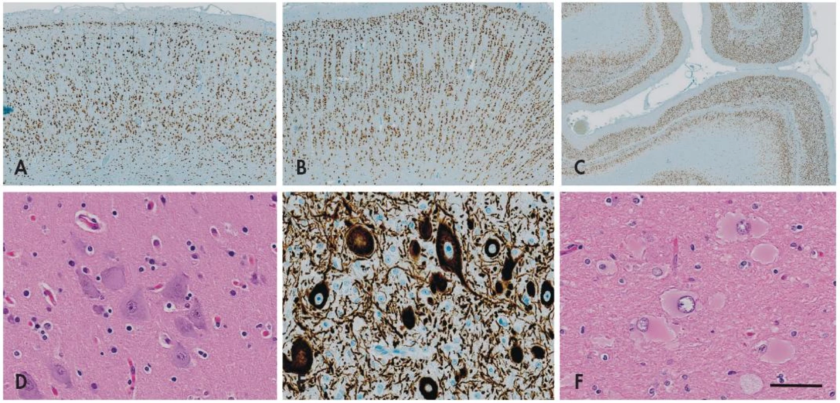 Fokální kortikální dysplazie (FCD). Imunohistochemický průkaz neuronálního jaderného antigenu neuN prokazuje normální hexalaminární uspořádání nemalformované mozkové kůry (A). V případě <em>fokální kortikální dysplazie I. typu</em> dochází k tvorbě clusterů a vertikálních neuronálních sloupců v postižené kůře (B). Vzácně může být porucha laminárního uspořádání nikoli vertikální (radiální) ale v horizontální (tangenciální) rovině - FCD typu IB v nové klasifikaci ILAE 2011 (C).
<em>Fokální kortikální dysplazii II. typu</em> charakterizuje přítomnost tzv. dysmorfních neuronů, které se vyskytují jednotlivě nebo ve skupinkách nepravidelně v celé šíři kůry, mají bizarní tvar a jejich velikost je často větší než u Betzových pyramidových buněk (D). Tyto buňky vykazují abnormální reakce při průkazu neuronálních markerů, zejména fosforylovaných neurofilament (E). U FCD typu IIB se k cytoarchitektonickým poruchám s dysmorfními neurony přidává přítomnost tzv. balónovitých buněk. Jsou to veliké buňky vyskytujících se jednotlivě nebo ve skupinách v oblasti přechodu mezi bílou hmotou a kůrou, mají obšírnou bledou eozinofilní cytoplazmu a excentricky uložené vezikulární jádro (F). Měřítko - 1000 μm (A), 800 μm (B), 200 μm (C), 100 μm (D-F).