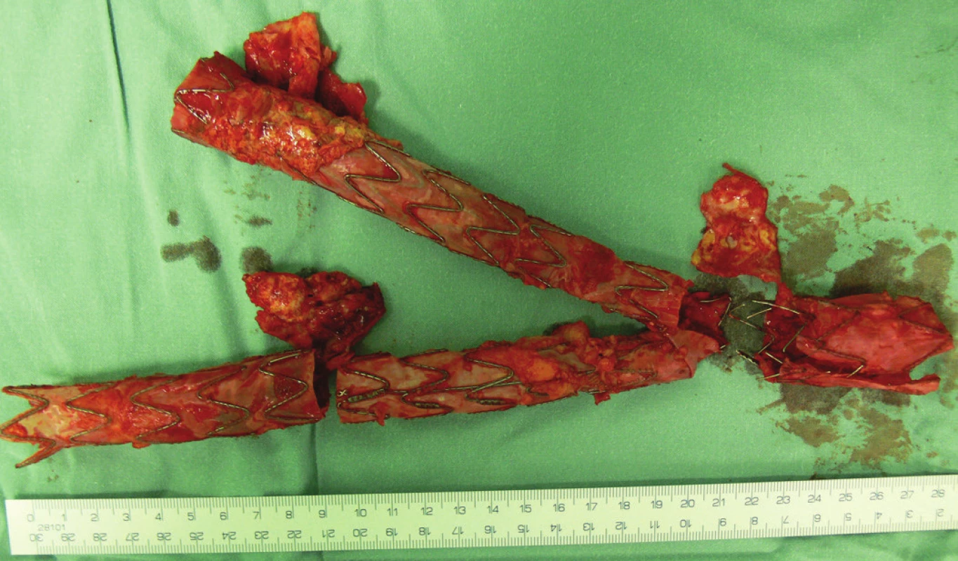Odstraněný stentgraft včetně extenzí
Fig. 11: Removed stentgraft including extensions
