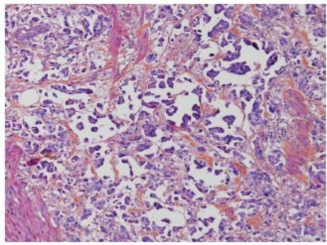 IMPC, hollow spaces around the micropapillae. No fibrovascular cores in the papillae.