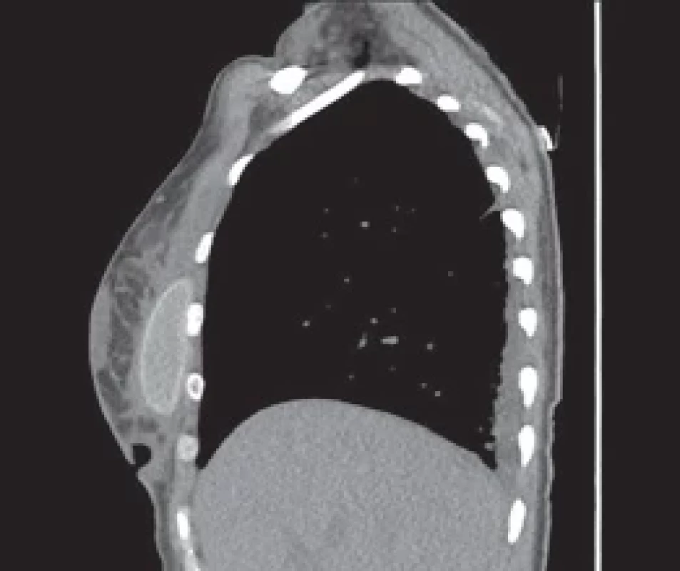 Initial CT scan – implants, pre-implants collection, gas bubbles and reactive pleural eff usion.