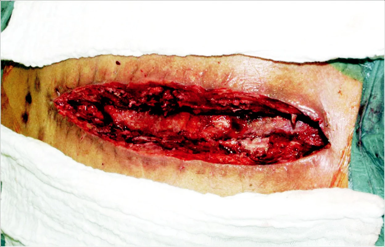 Hluboká sternální infekce. Debridement před aplikací VAC systému
Fig. 1. Deep sternal infection. Surgical debridement prior to application of the VAC system