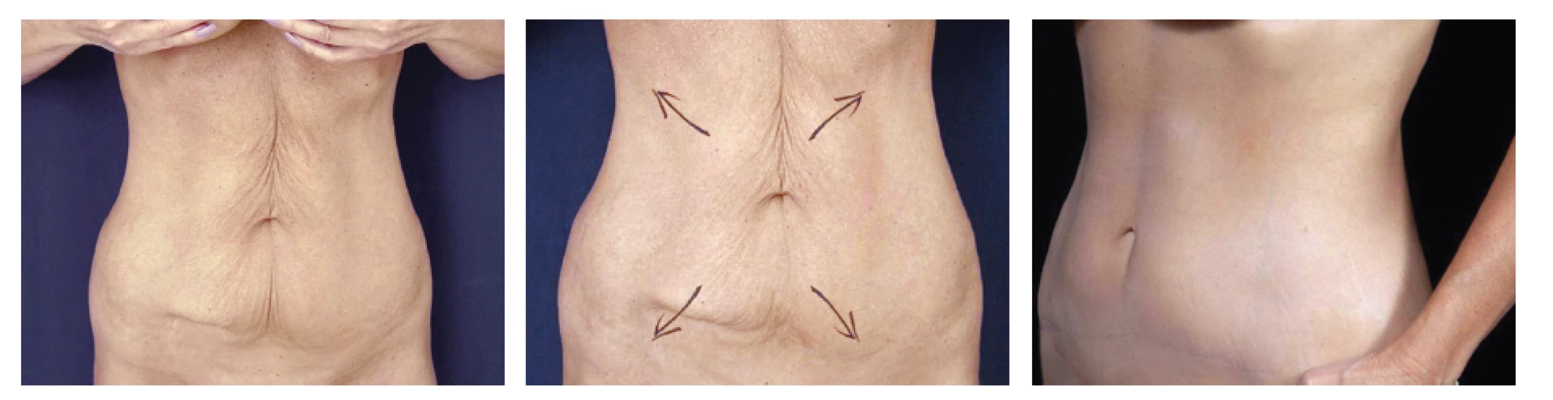 Horní a dolní miniabdominoplastika u 59 leté ženy
Fig. 6: Upper and lower abdominoplasty in a 59 year old female