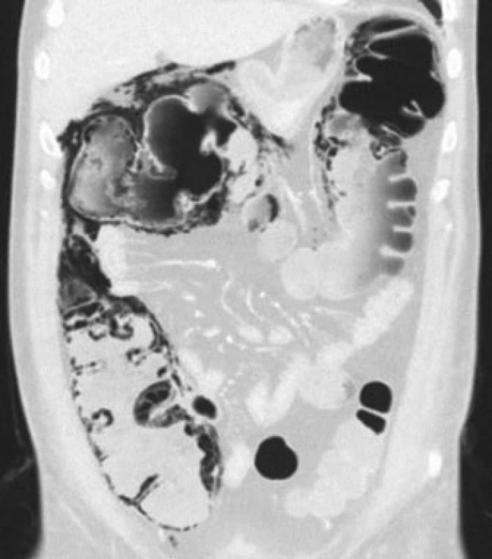 CT, koronární řez, plicní okno. Plyn ve stěně pravého tračníku, pneumoperitoneum.