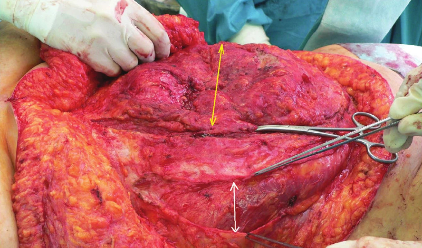 Přední komponent separace před rekonstrukcí „střední čáry“ Bílá šipka – separace, žlutá defekt fascie/branka kýly.
Fig. 7: Anterior component separation prior to midline reconstruction
White arrow –component separation, yellow fascial defect/ hernia width.
