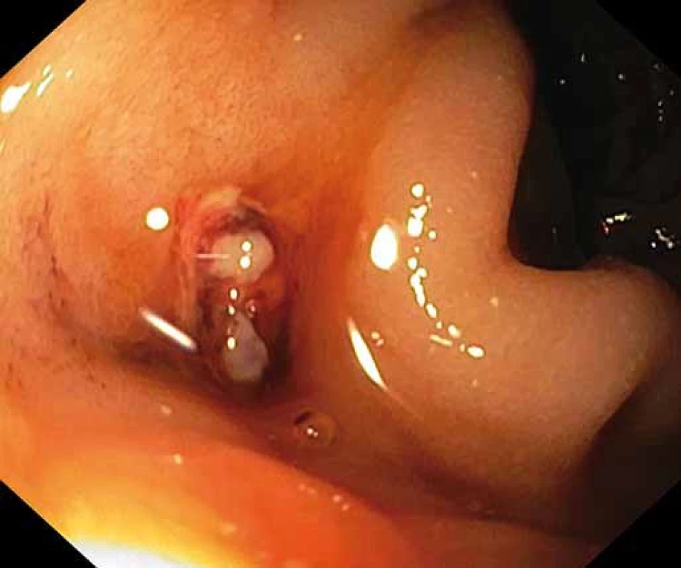 Ústí protézoenterální píštěle v duodenu.
Fig. 1. Prosthetic-enteral fistula orifice into the duodenum.