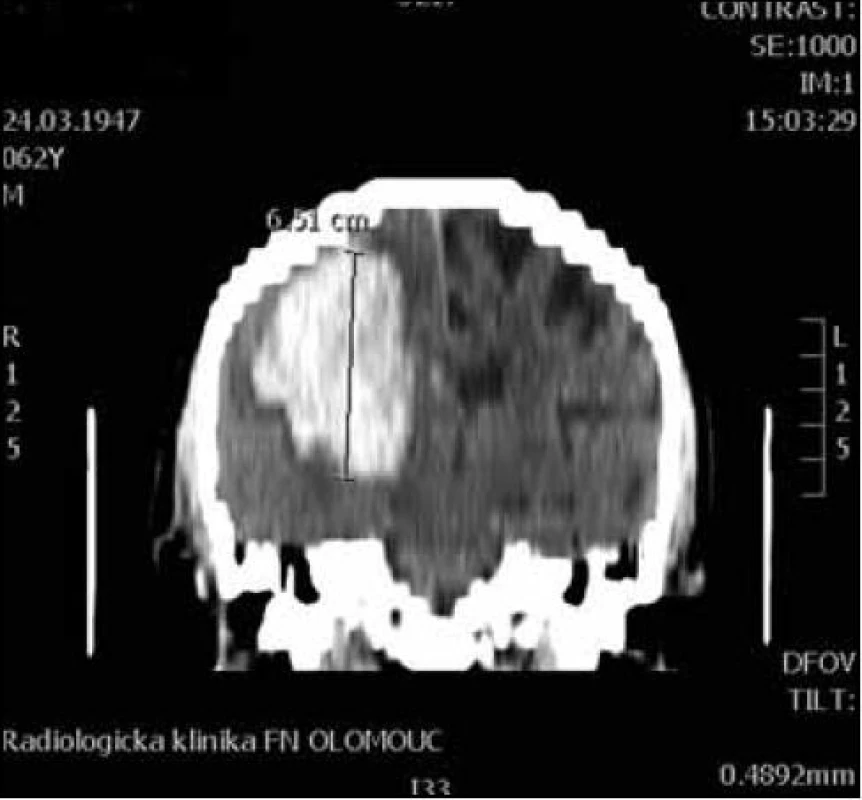CT koronární rekonstrukce pro orientační výpočet objemu a × b × c / 2 (osa c).