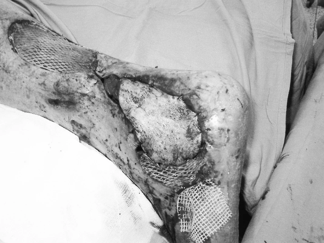 Pooperační stav po vykrytí defektu suralis lalokem a odběrového místa volným transplantátem
Pic. 3. Postoperative condition using suralis flap for the defect coverage. The graft site is covered by a free transplant