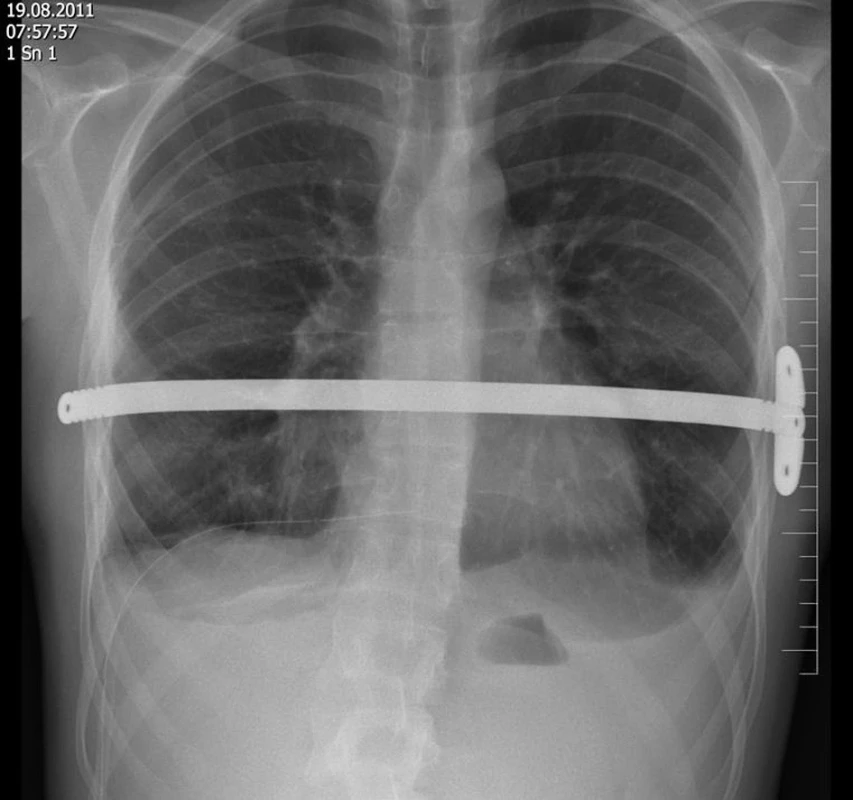 Pooperační snímek hrudníku po implantaci dlahy se stabilizátorem
Fig. 4: Postoperative chest X-ray after the metal bar insertion with a stabilizer