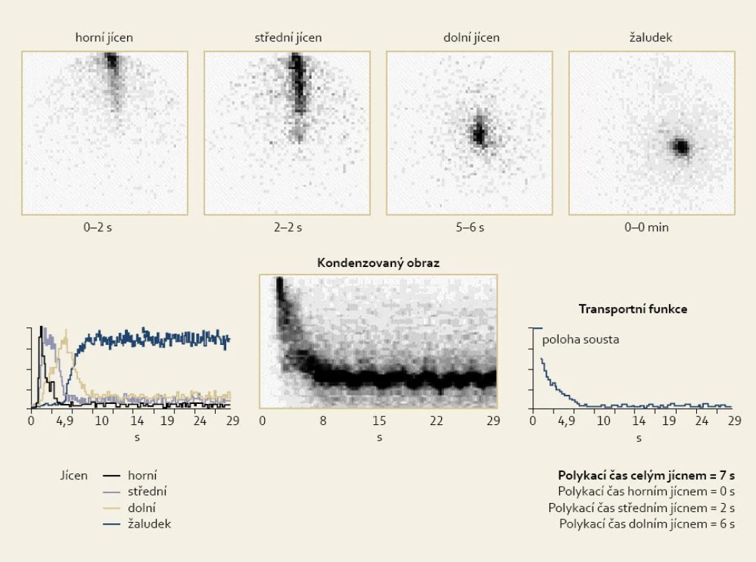 Normální nález tranzitu jícnem.
Fig. 1. Normal finding of oesophageal transit.